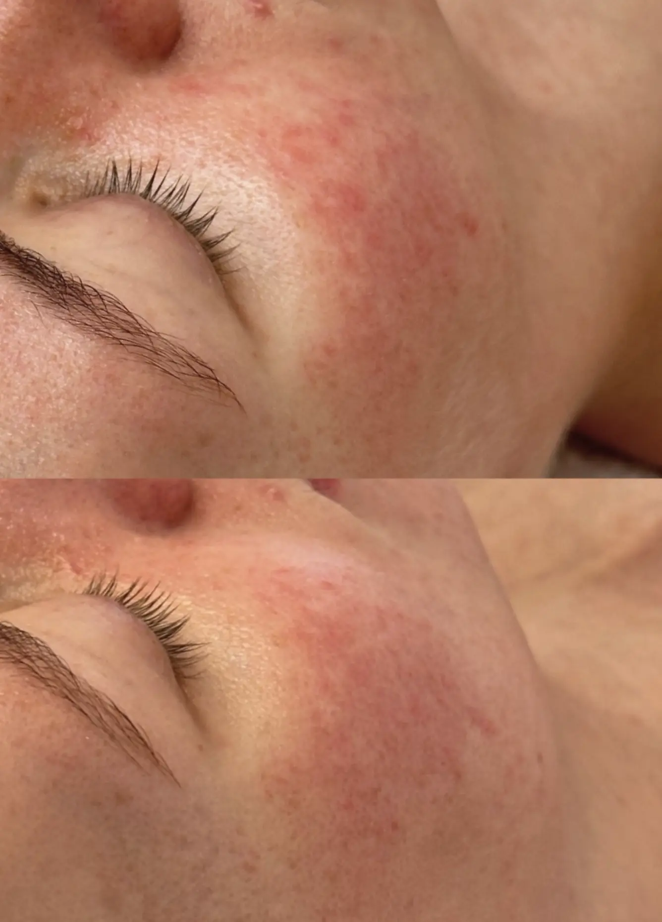 Hilton Strasbourg | Seasonal Skincare: How to Adjust Your Routine for Changing Weather dermaplaning cost australia